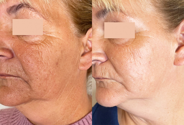 Benefits of Microneedling - Collagen Induction Therapy