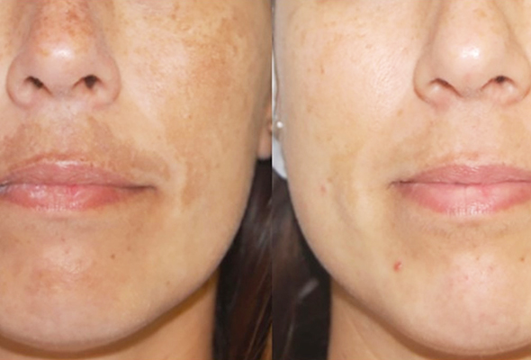 Laser Facial Treatments
